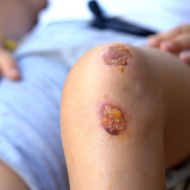 Treatment for chronic non-healing wounds